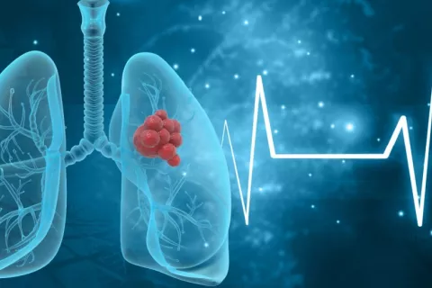 Ilustración de pulmones humanos con células tumorales