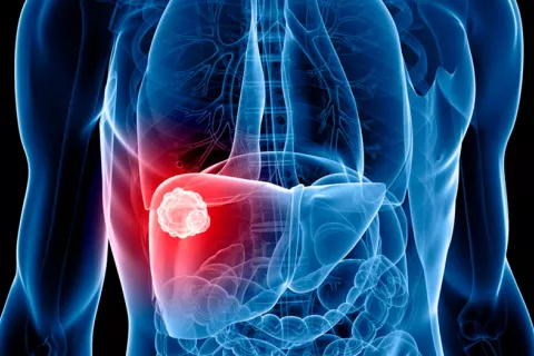 Inmunoterapia para tratar cáncer hepático avanzado Ilustración en 3D de un hepatocarcinoma irresecable