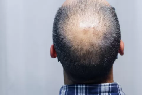 Hombre con pérdida de cabello por alopecia areata Cabeza de hombre en la que se aprecia la pérdida de cabello