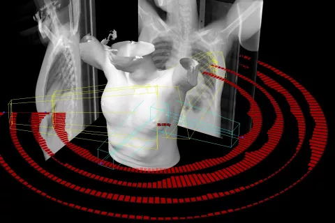 Paciente de cáncer de mama radiada Imagen 3D de un tratamiento radioterápico en paciente con cáncer de mama