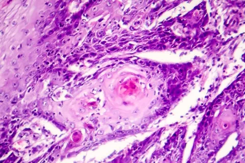 Vista de carcinoma cutáneo de células escamosas a través del microscopio