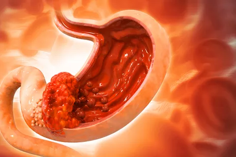 Cáncer de estómago o cáncer gástrico Ilustración de cáncer de estómago o cáncer gástrico