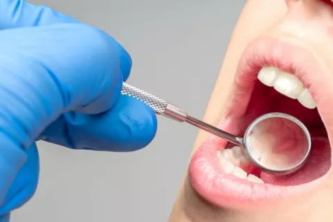 Dentista comprueba la presencia de periodontitis Mano del dentista examina boca paciente con espejo dental