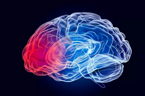 Ilustración de un cerebro afectado por párkinson