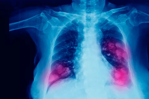 Radiografía torácica de un paciente que muestra cáncer de pulmón