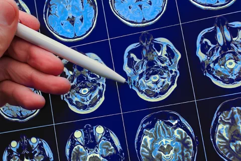 Riesgo genético de padecer alzhéimer Imágenes cerebrales muestran riesgo genético de alzhéimer