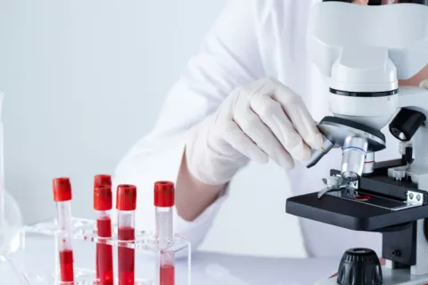 Tubos de ensayo contienen sangre para ser examinada en busca de signos de cáncer Científica examina sangre en un microscopio en el laboratorio