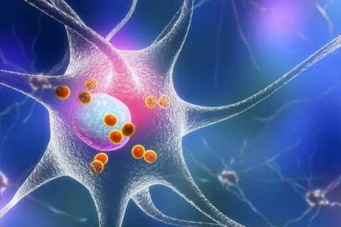 Ilustración en 3D de neuronas que se degeneran por enfermedad de Parkinson