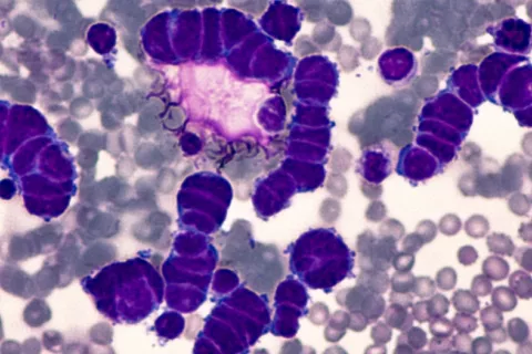  Imagen microscópica de la citología del fluido pleural de un carcinoma de célula pequeña