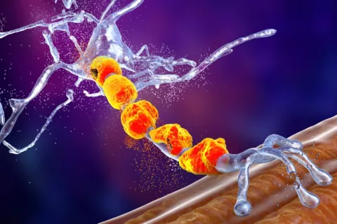 Ilustración en 3D de neuronas motoras degradadas por ELA
