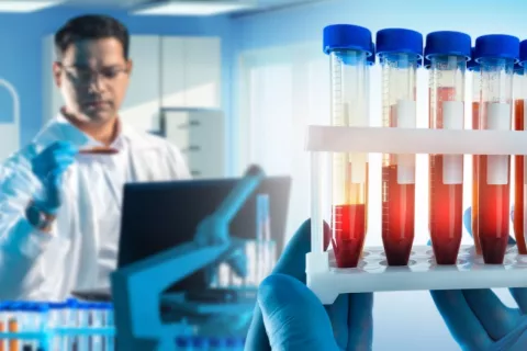 Científico analiza muestras de sangre de pacientes de ELA Investigador junto a frascos que contienen sangre en un laboratorio