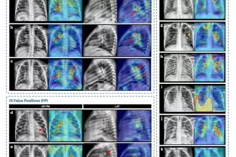 Mapas de activación generados mediante técnicas de explicabilidad que señalan las regiones de interés utilizadas por el modelo para tomar sus decisiones sobre las radiografías Radiografías de tórax