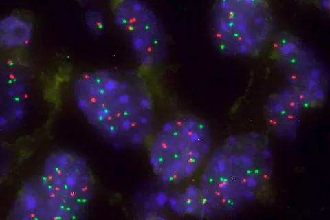 Imagen de un grupo de células tumorales pulmonares con aumento de KRAS para superar la barrera natural Capicua Imagen de un grupo de células tumorales pulmonares con aumento de KRAS para superar la barrera natural Capicua