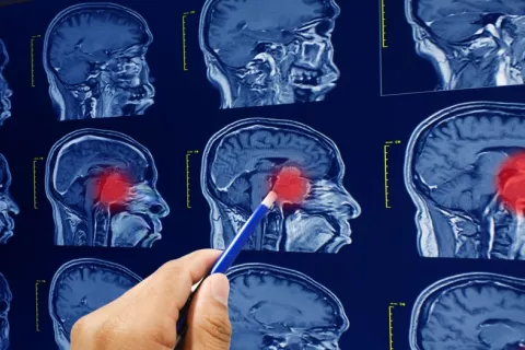 Médico revisa resonancias magnéticas del cerebro y tumores cerebrales