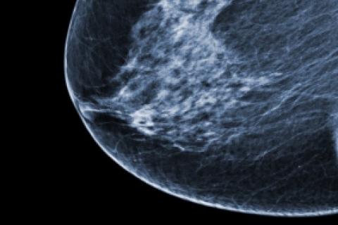 Ecografía de la mama con tumor