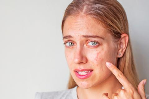 Chica mayor de 20 años con signos de acné en el rostro