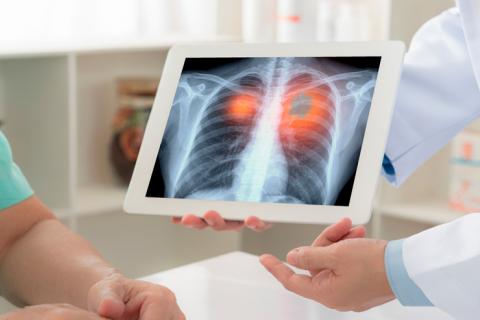 Médico mostrando un diagnóstico de cáncer de pulmón