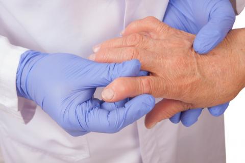 Paciente con artritis reumatoide