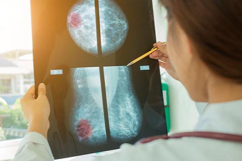 Diagnóstico de cáncer de mama ante una prueba de contraste