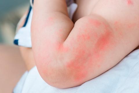 Niño con problemas de dermatitis atópica