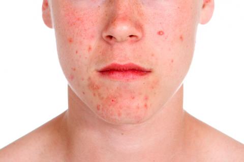 Adolescente con acné