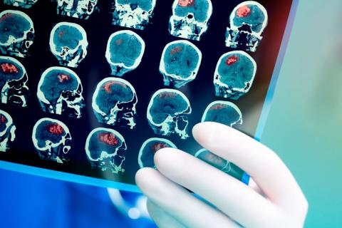 Radiografía del cerebro para un posible tratamiento del ictus