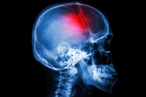 Radiografía del cerebro tras un ictus