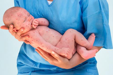 El herpes neonatal afecta a  recién nacidos cada año