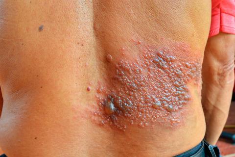 Espalda de un anciano con una infección por el virus del herpes zóster