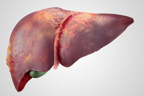 Gráfico de un hígado afectado de cáncer