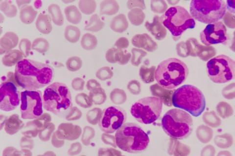 Células de sangre de la leucemia.