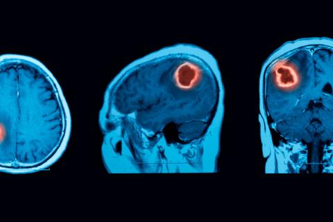 Escáner de un cerebro mostrando un glioma