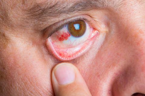 Abrasión corneal en en el ojo