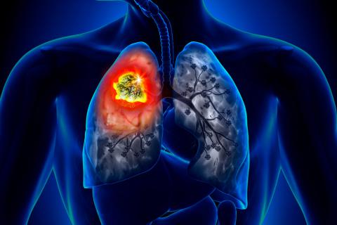 Ilustración del cáncer de pulmón
