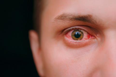 Ojos con señales de conjuntivitis