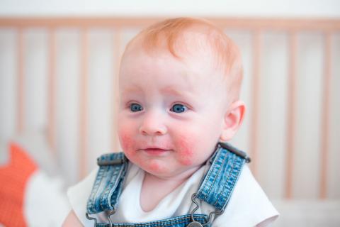 Niño pequeño con signos de dermatitis atópica en la cara