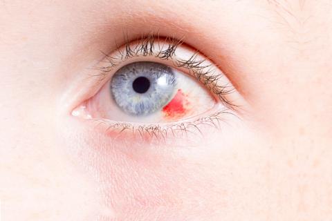 Detalle de un derrame ocular