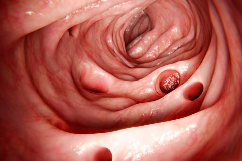 Divertículos en la pared del intestino grueso