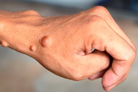 Neurofibromatosis, qué es