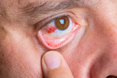 Abrasión corneal en en el ojo