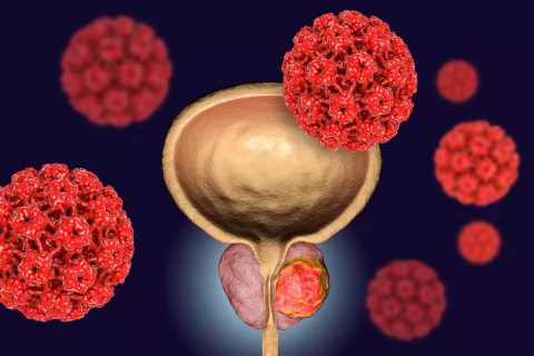 Tumor en la próstata