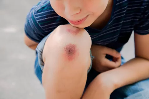 Niño con contusión en la rodilla