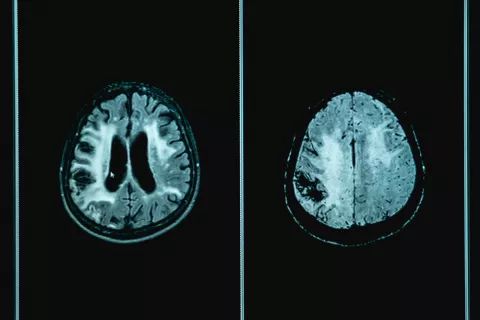 Pruebas diagnósticas de demencia vascular