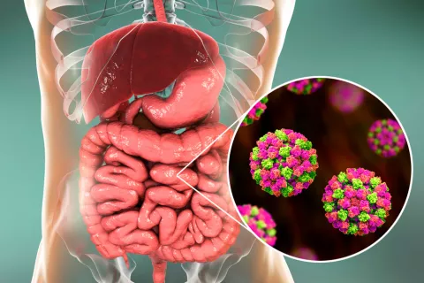 Infección intestinal por norovirus
