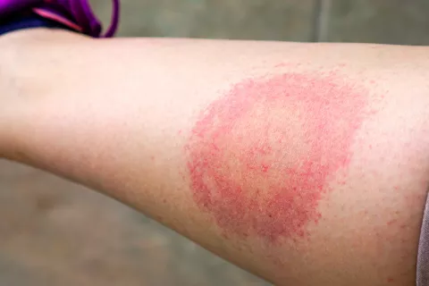 Picadura de garrapata síntoma de la enfermedad de Lyme