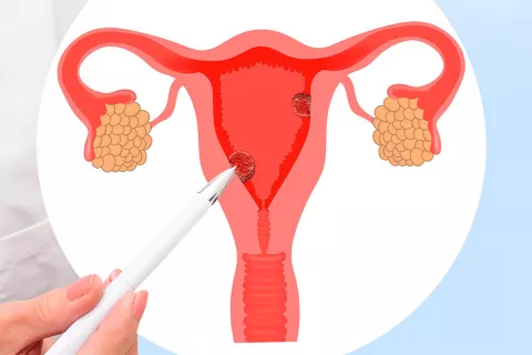 Pólipos uterinos Causas, síntomas y tratamiento
