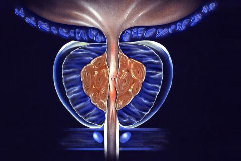 Ilustración de la hiperplasia benigna de próstata