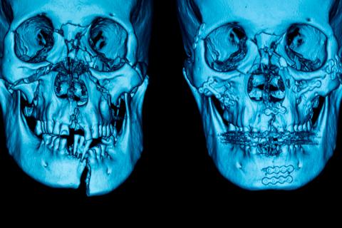 Lesiones maxilares: radiografía