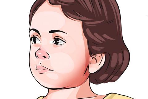 Ilustración de una niña con paperas