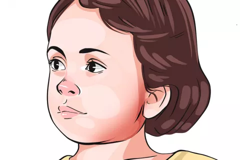 Debilidad diseñador Palmadita Paperas Causas, síntomas y tratamiento